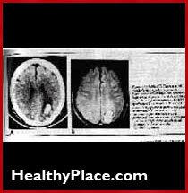 طبيب الأعصاب جون فريدبرغ كيف المخدرات النفسية والصدمات الكهربائية تلف الدماغ. يقول جميعهم يعانون من تلف في الدماغ وفقدان الذاكرة.