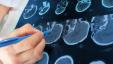 عمليات مسح الدماغ ثلاثية الأبعاد قد تزيد من دقة تشخيص اضطراب نقص الانتباه وفرط الحركة