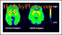 تم استخدام المصطلحين ADD و ADHD بالتبادل. ومع ذلك ، فإن المصطلح المحدّث ، وفقًا لـ DSM IV ، هو ADHD (اضطراب فرط الحركة ونقص الانتباه).